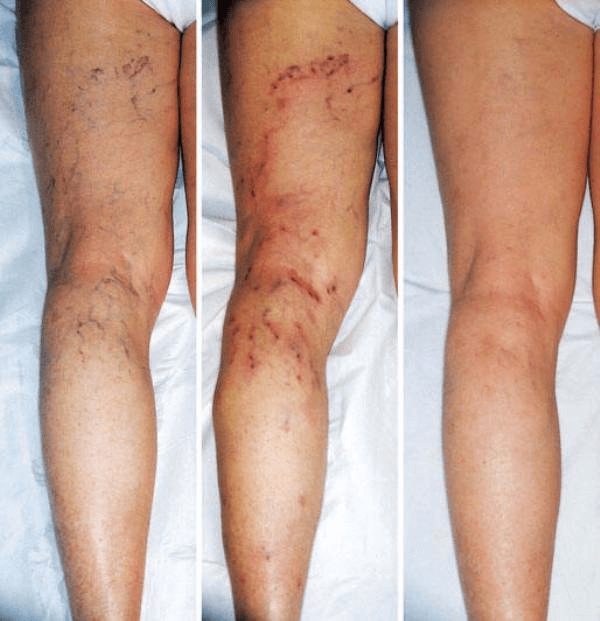 Eczema varicoza picior. Tratament eczema varicoză picioare